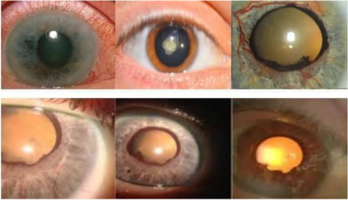 Beispiele für krankhafte Veränderungen am Auge