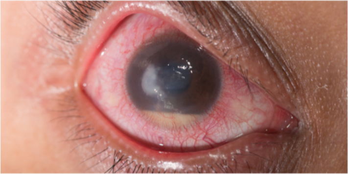 Auge mit Glaukom